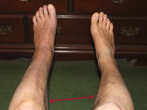 The Incredible, Disappearing Calf Muscle